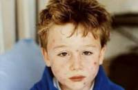 Детвора может на каникулах повально слечь с ветрянкой. Эпидемия уже на подходе